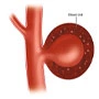 Pseudoaneurysm
